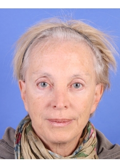 Before Hair Transplant&nbsp;Hair Thinning